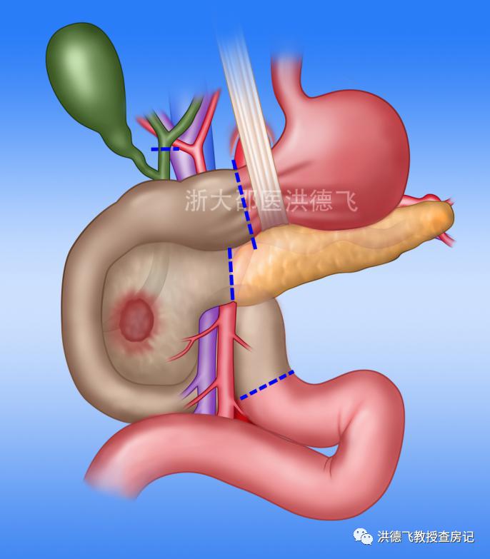 胰腺结石和胰腺癌区别,长了10多年的结石喝水能冲下去吗