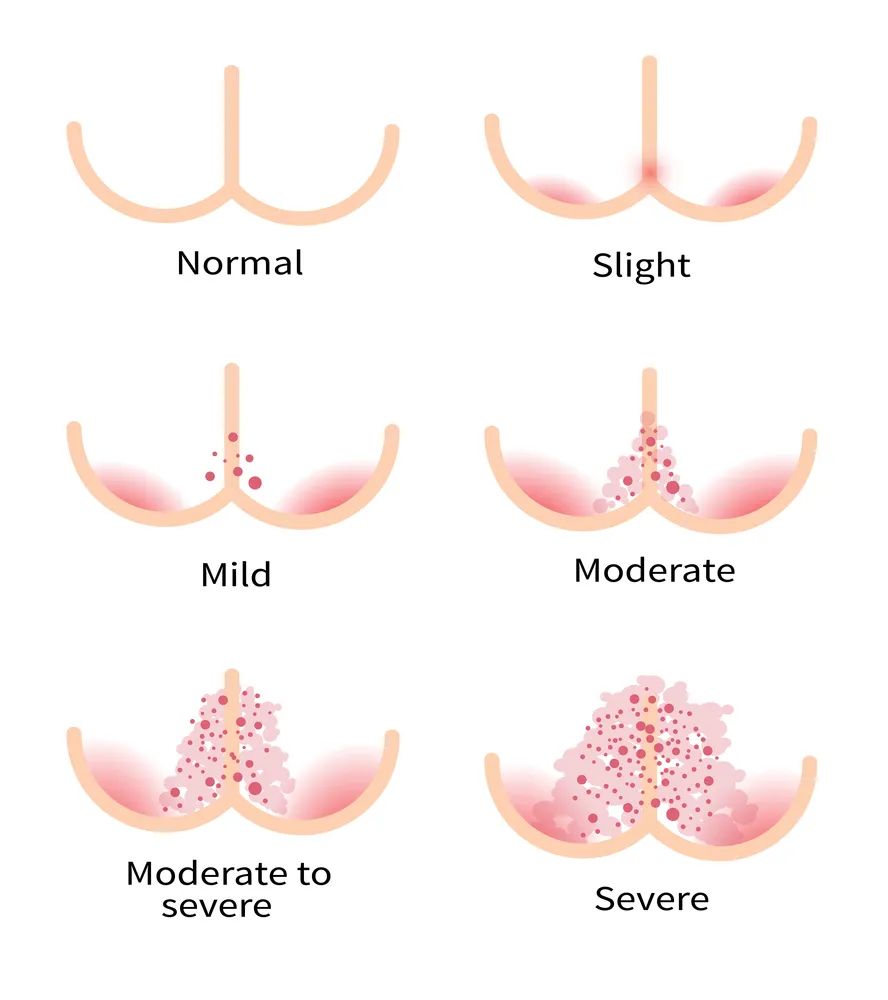 老人热天用什么尿不湿,天热了晚上穿尿不湿有什么好办法
