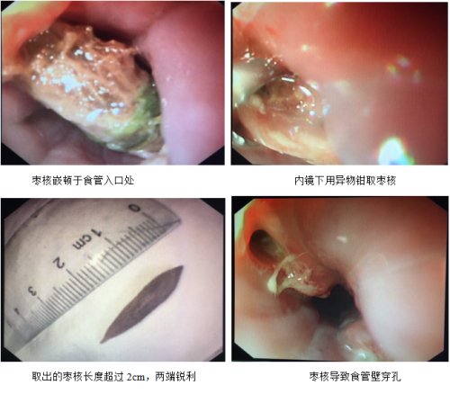 端午节吃枣要谨慎,端午节吃粽子慎防食用返青粽