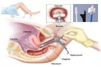 宫颈细胞学检查是怎么回事,宫颈细胞学检查di值超标