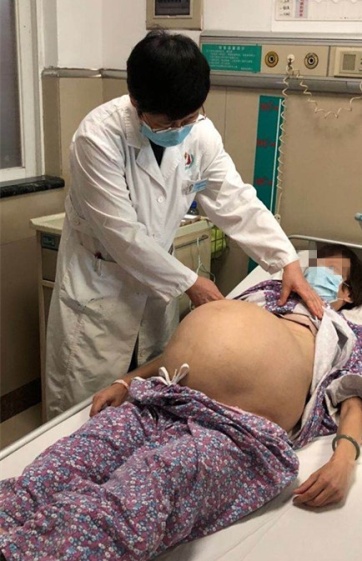 28岁女子取出80多个子宫肌瘤,55岁阿姨巨型肌瘤