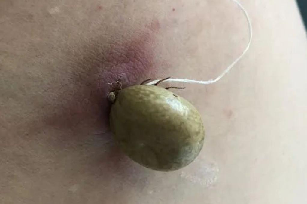 虫子爬到身体里,虫子爬到后背皮肤里面去了