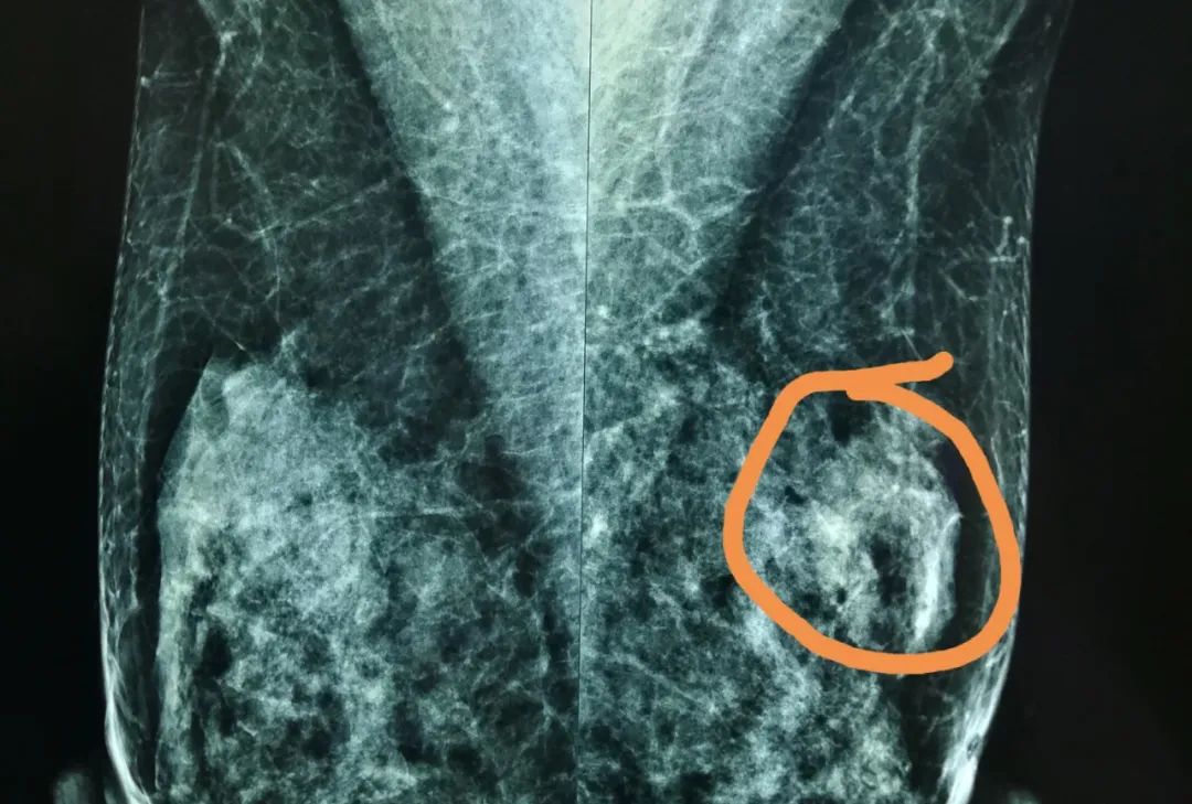 乳腺结节黄豆大小是早期乳腺癌吗,乳腺结节黄豆大小会是乳腺癌吗