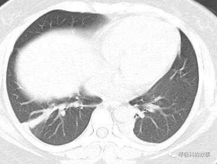 五花八门的发热之一—药物热（1）