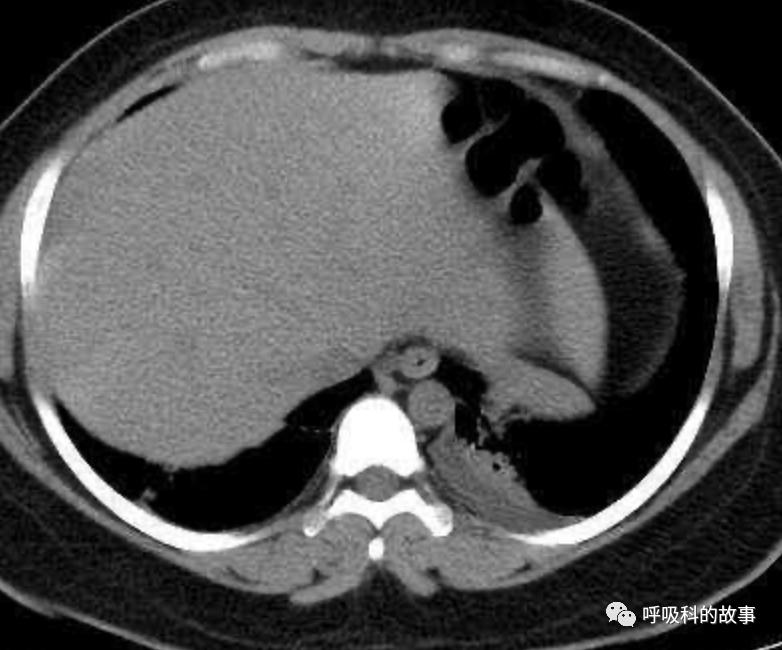 五花八门的发热之一—药物热（1）