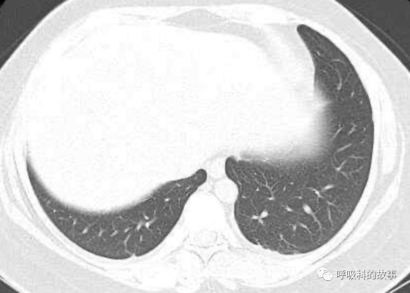 五花八门的发热之一—药物热（1）
