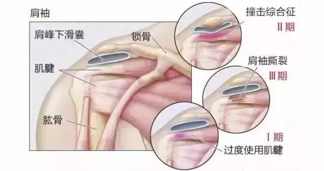 肩袖撕裂和肩峰撞击综合征一样么,肩峰下撞击综合征最佳治疗方法