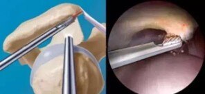 肩袖撕裂和肩峰撞击综合征一样么,肩峰下撞击综合征最佳治疗方法