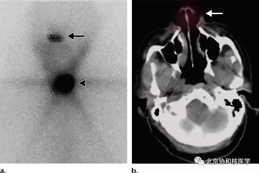 碘扫描最坏的结果,放射性核素扫描可以鉴别诊断吗