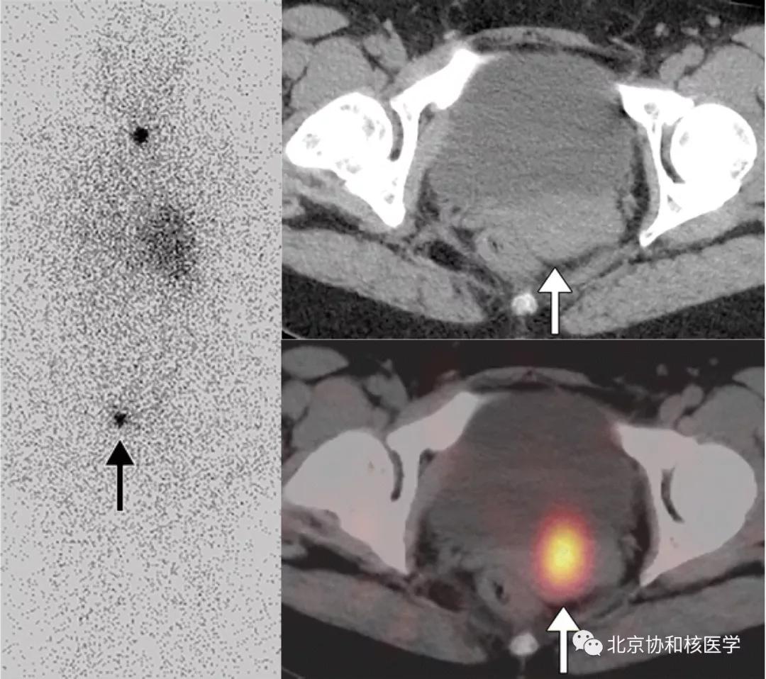 碘扫描最坏的结果,放射性核素扫描可以鉴别诊断吗
