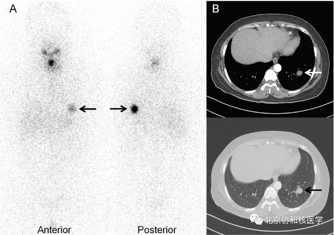 碘扫描最坏的结果,放射性核素扫描可以鉴别诊断吗