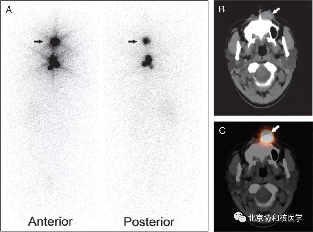 碘扫描最坏的结果,放射性核素扫描可以鉴别诊断吗