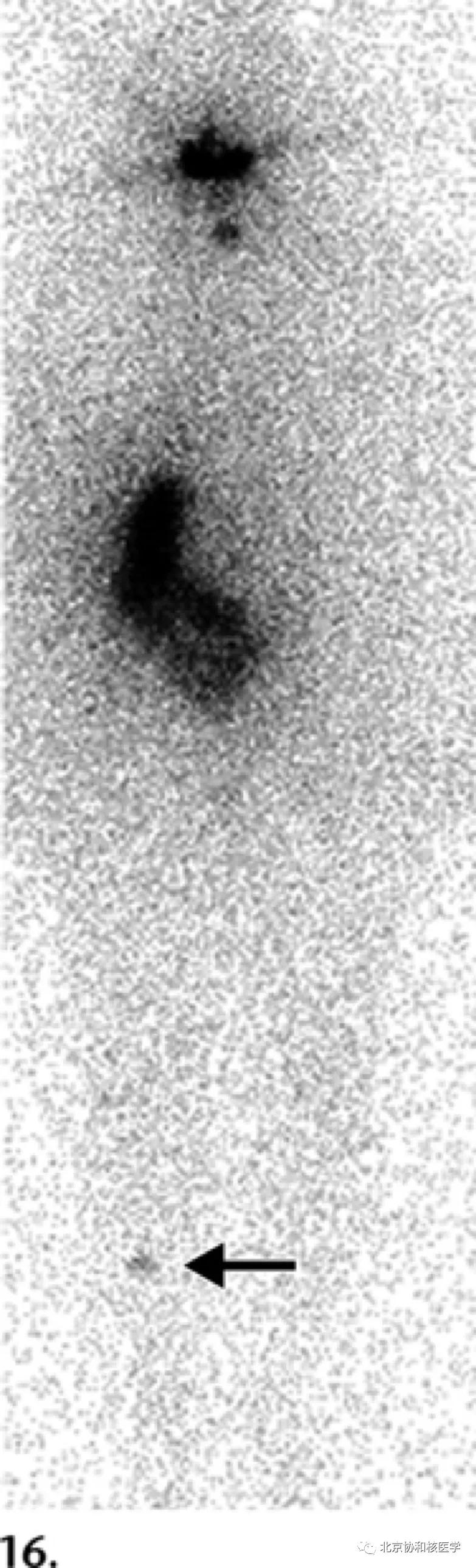 碘扫描最坏的结果,放射性核素扫描可以鉴别诊断吗