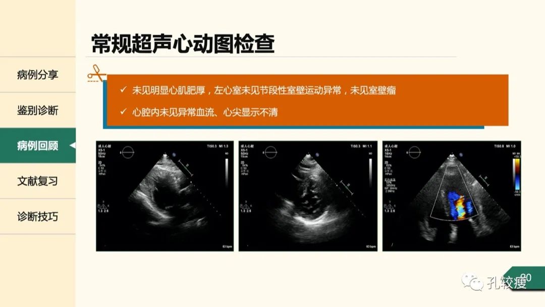 t波倒置在心电图中怎么看,T波低平心电图讲解