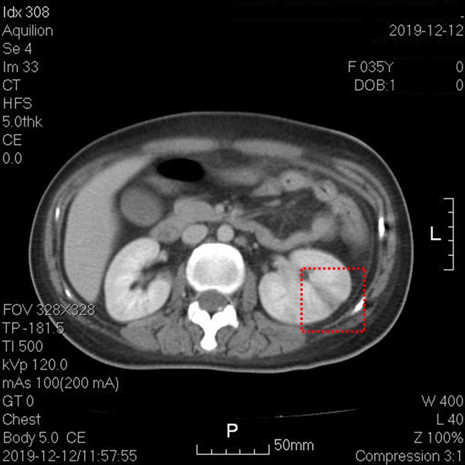 快看！心脏“漏了个洞”，人竟然还活着……