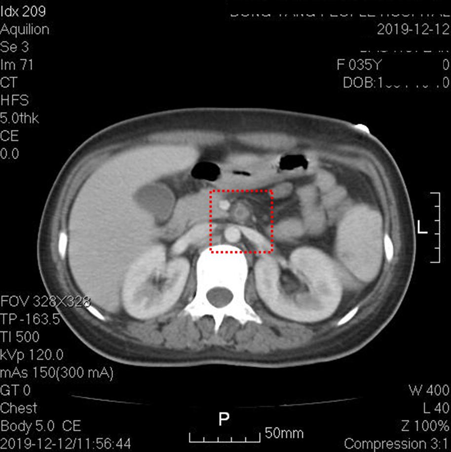 快看！心脏“漏了个洞”，人竟然还活着……