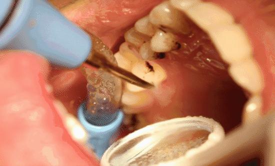 【提醒】OMG！才30多岁，一口牙就要被拔光？有这些症状赶快去看