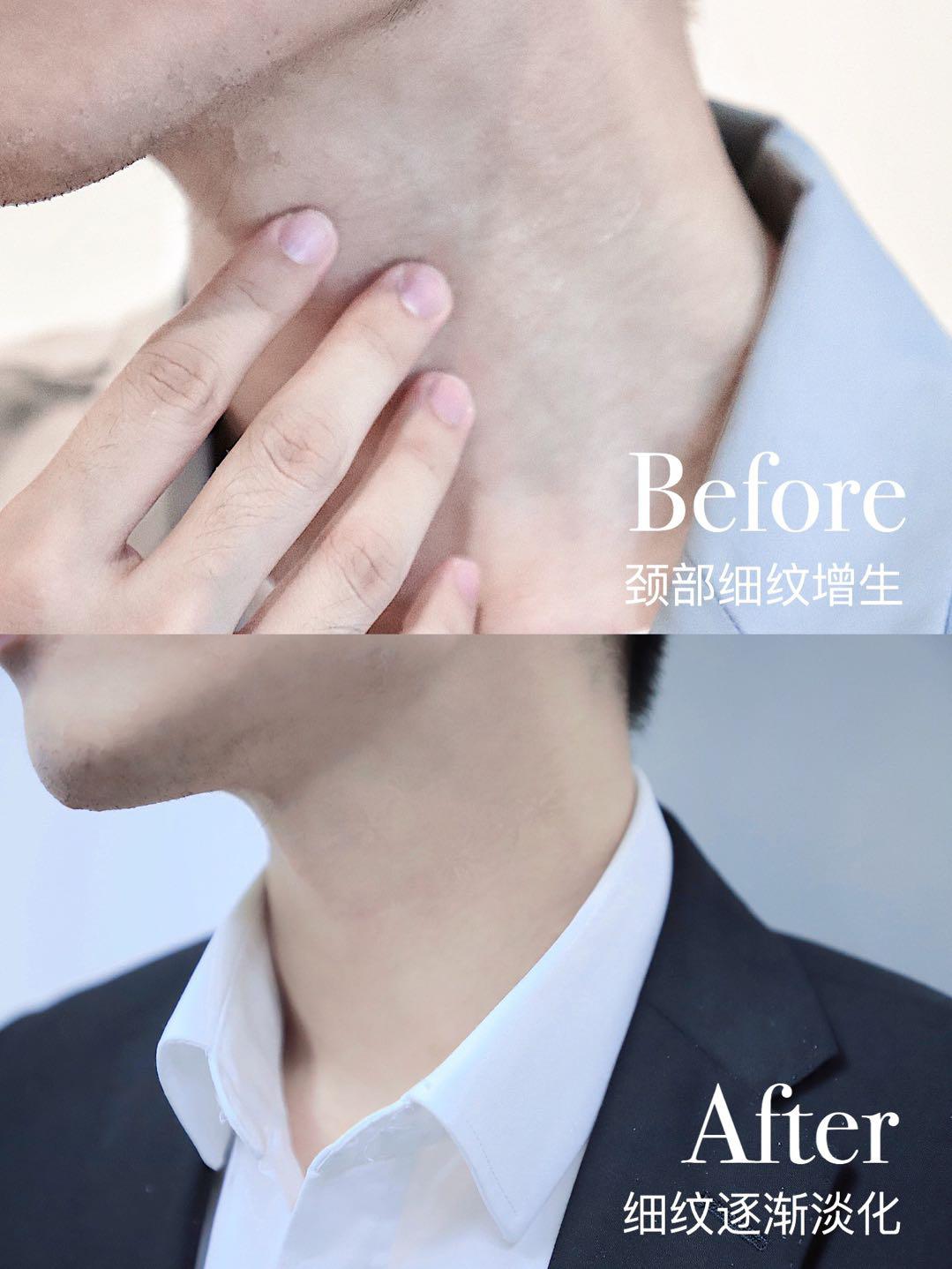 一条颈纹老十岁教你一招淡化,女人脖子有颈纹和年龄有关吗