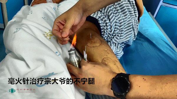 夏天穿两层棉裤还是冷，大爷无奈刺入烧红的钢针，效果竟出乎意料！【针灸宝鉴】