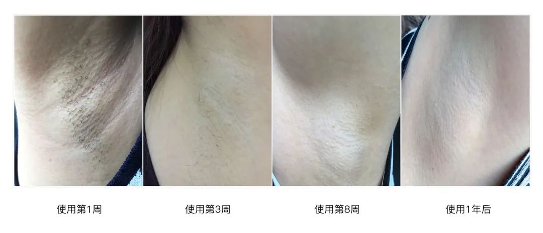 胸毛、脚趾毛、*处私**的毛能不能脱？一篇说清楚