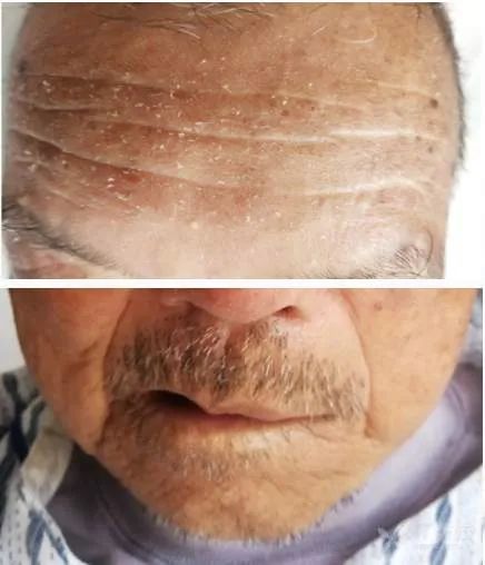 90岁老人面瘫怎么处理,老人面瘫轻度怎么治疗