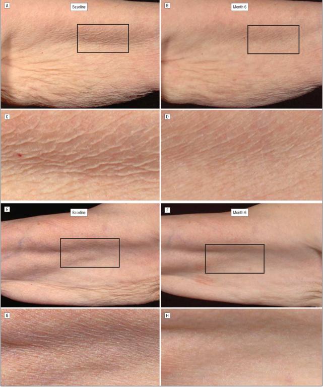 法令纹怎么办,脸上长皱纹怎么办