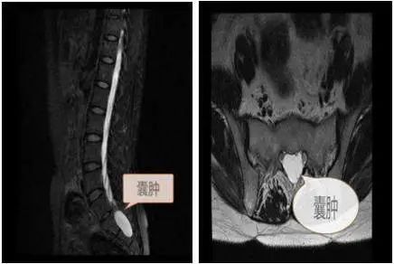 骶管囊肿有多大的危害怎么能治愈,骶管囊肿严重了最坏的可能是什么