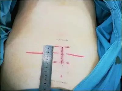 骶管囊肿有多大的危害怎么能治愈,骶管囊肿严重了最坏的可能是什么