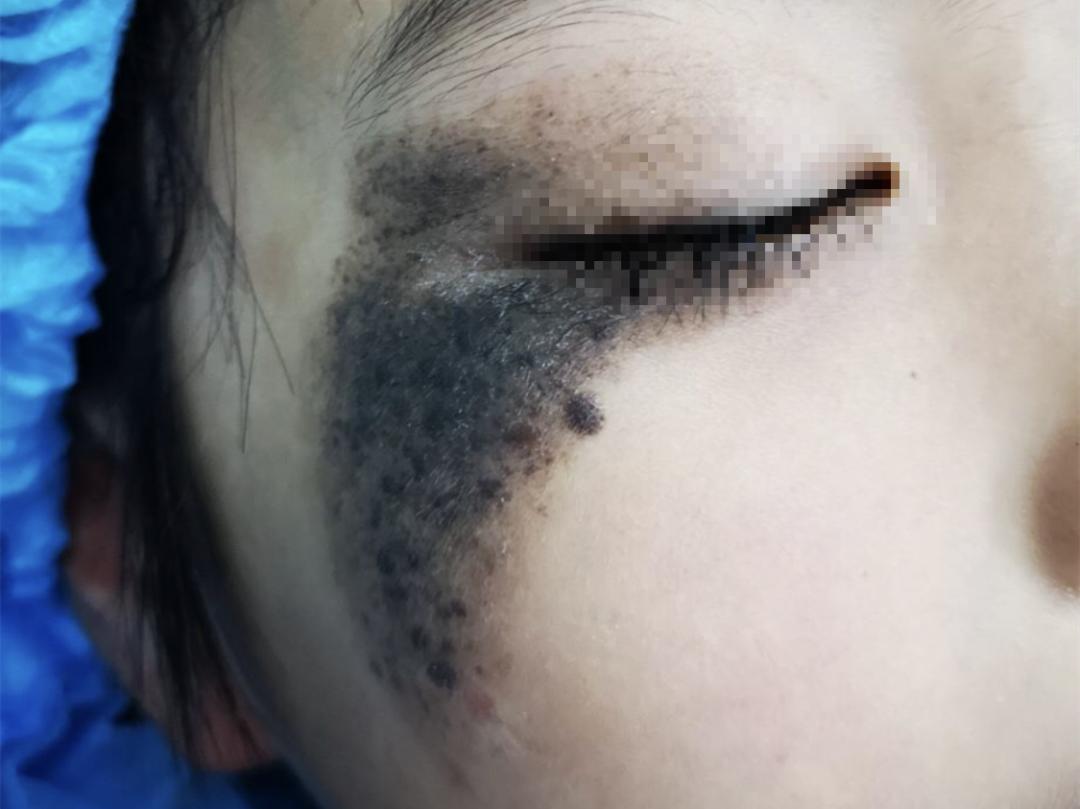 【专家在身边】右脸大面积黑斑，还长毛发！2年多的精心治疗，让大眼萌娃有了正常肤色
