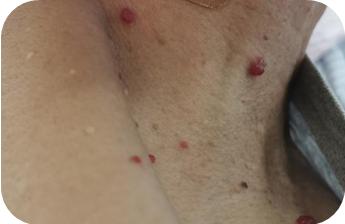 话肿瘤,肿瘤病人用了免疫治疗说胡话