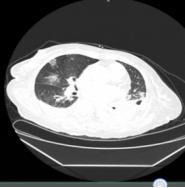 新冠肺炎冠状病毒,新型冠状病毒肺炎中医医案精选