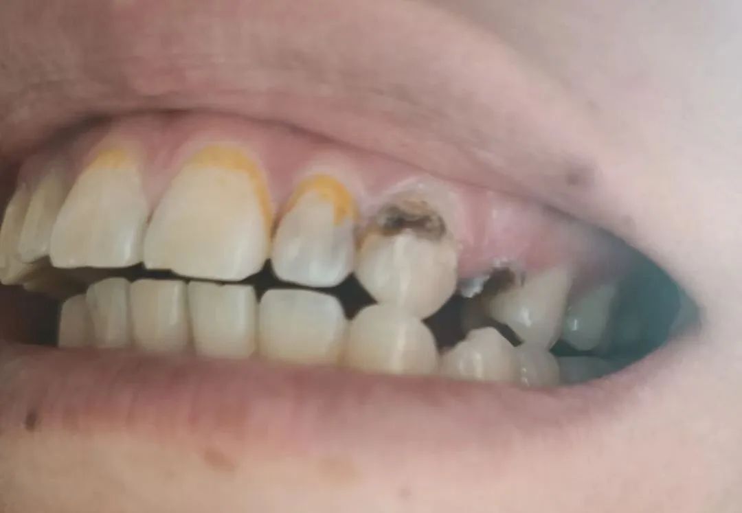 牙粉去烟渍牙结石牙膏排名第一名,美白牙膏推荐去牙黄老牌子