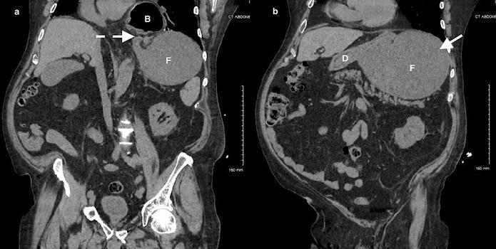 请简述急性腹痛的急诊处理流程,腹痛的急诊诊治思维