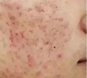 痘痘不再反复了怎么办,痘痘不消失怎么办