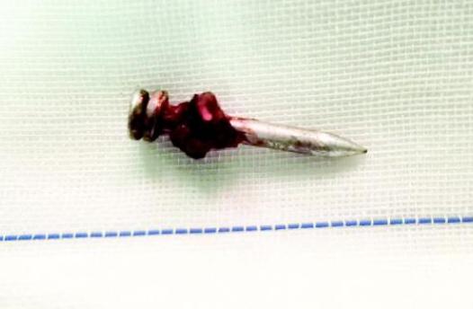 枪战中女子被击中,钉枪穿墙女子受伤