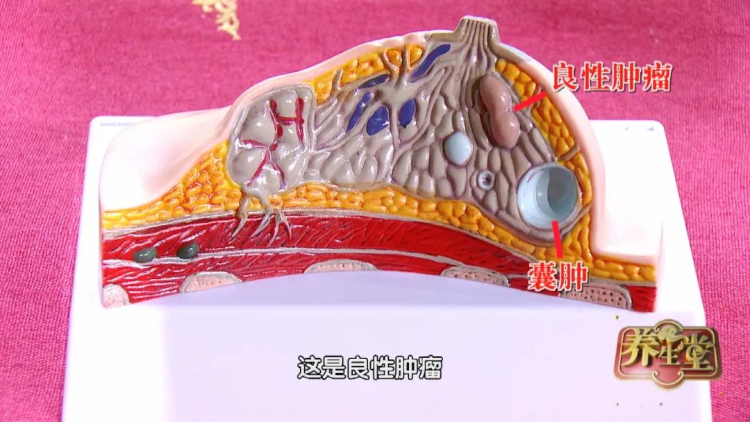 北京卫视养生堂中医治疗乳腺癌,养生堂乳腺癌