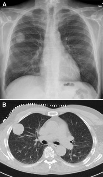 52岁男性肺部有肿块,老年男性胸痛的原因有哪些