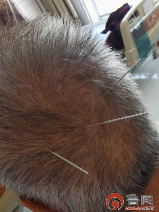 *安泰**市中医医院龙砂开阖六气针法助力脑病患者康复