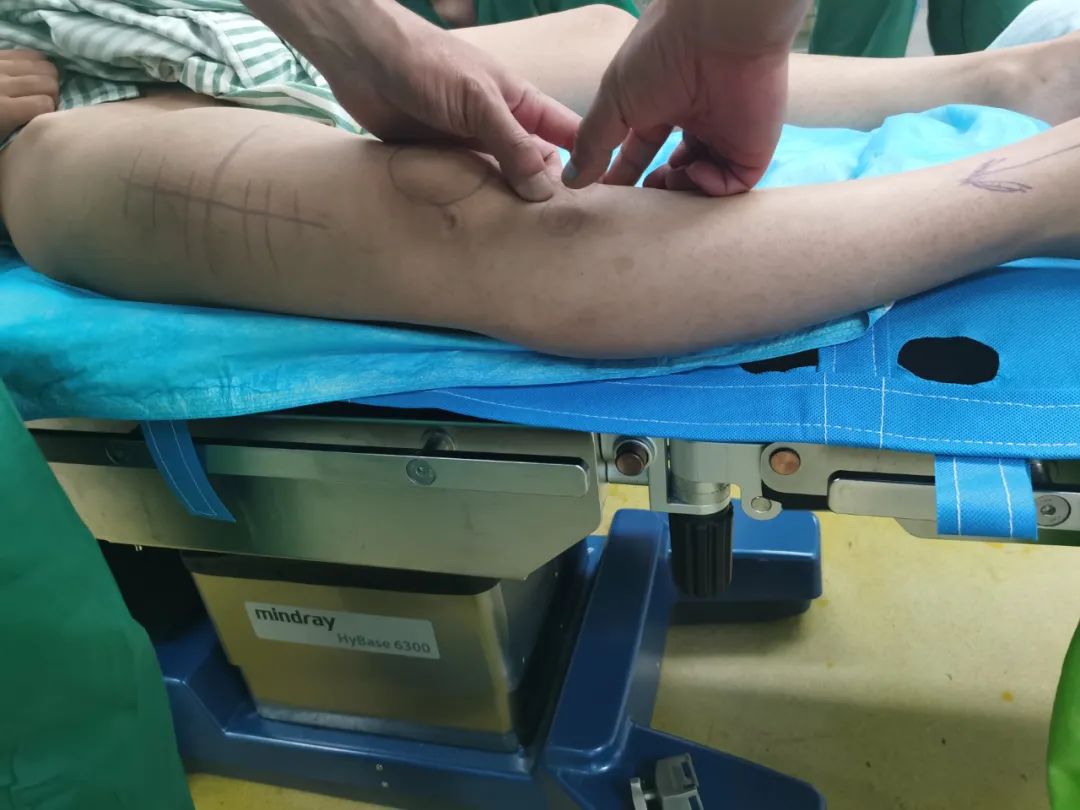 截骨手术是什么手术全过程,截骨矫形手术全过程