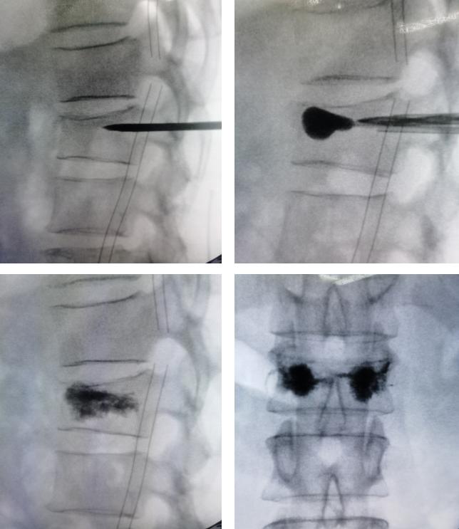 椎体压缩性骨折怎么治疗,谈骨论筋推拿正骨
