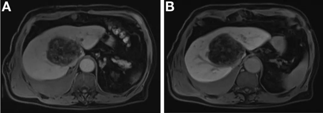 肝脏方面的病例,肝脏罕见病