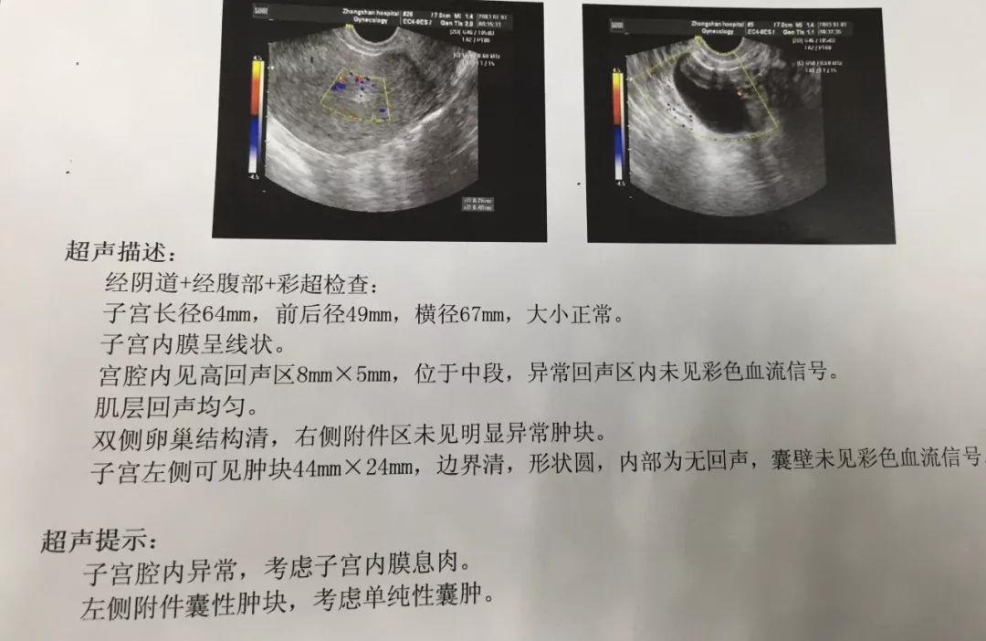 宫腔镜内膜息肉切除术影响怀孕吗,内膜息肉怀孕了对胎儿有影响吗