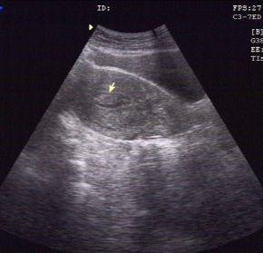 宫腔镜内膜息肉切除术影响怀孕吗,内膜息肉怀孕了对胎儿有影响吗