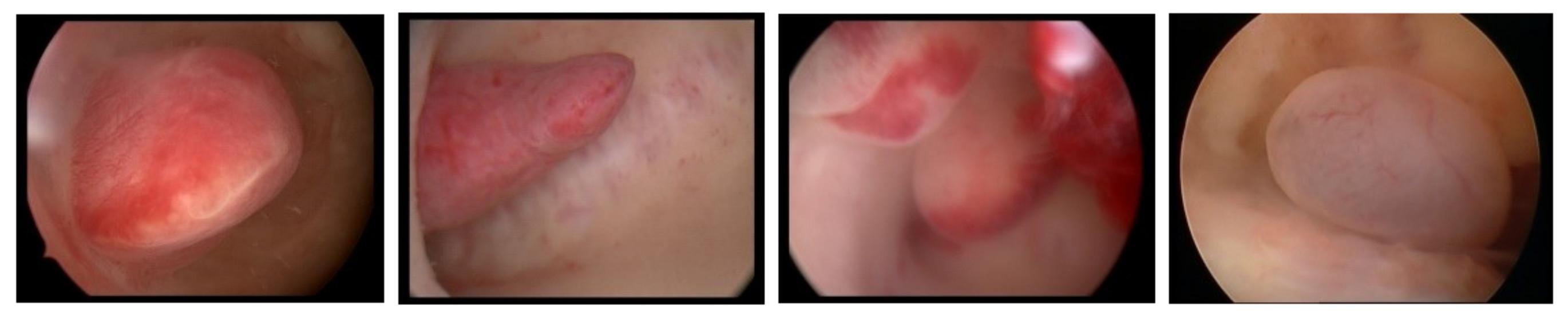 宫腔镜内膜息肉切除术影响怀孕吗,内膜息肉怀孕了对胎儿有影响吗