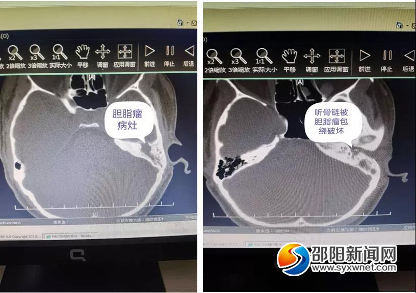 愿为您的耳朵带来“温度”——邵阳市中心医院耳鼻喉科人工听小骨植入听力重建术