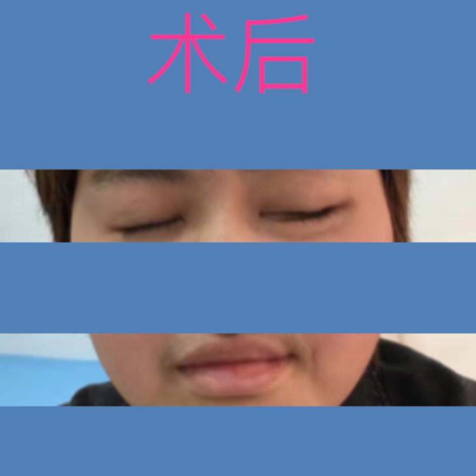 四川华西医院治疗面瘫怎么样,面瘫其实很难治愈