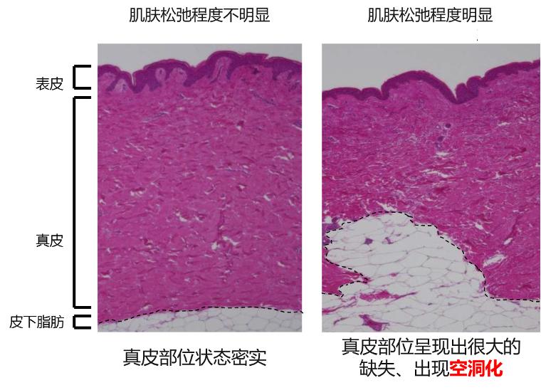 脸上有了皱纹抗老,抗皱要趁早等皱纹出来就晚了
