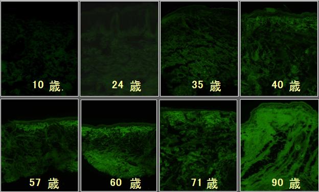 脸上有了皱纹抗老,抗皱要趁早等皱纹出来就晚了