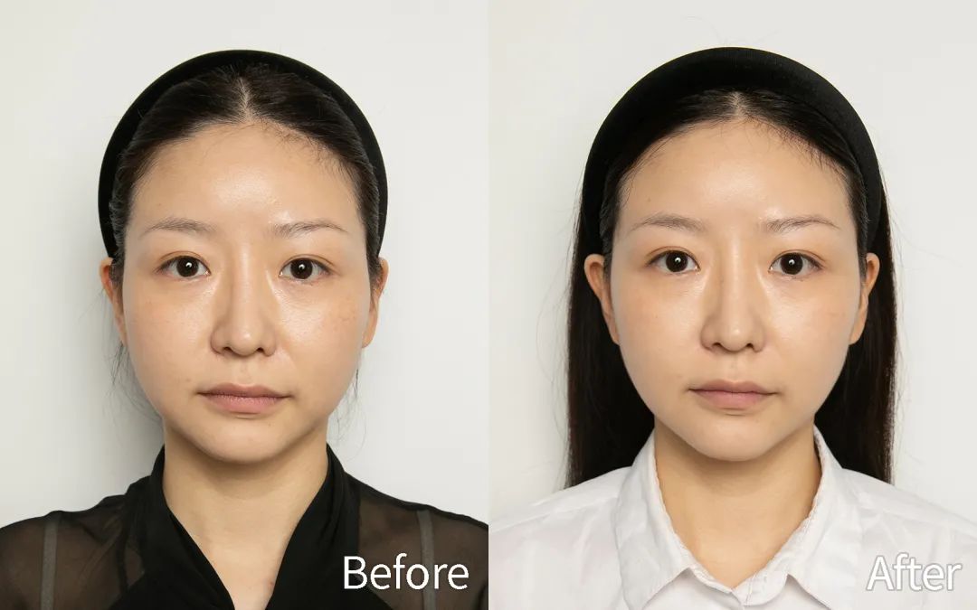 脸上有了皱纹抗老,抗皱要趁早等皱纹出来就晚了