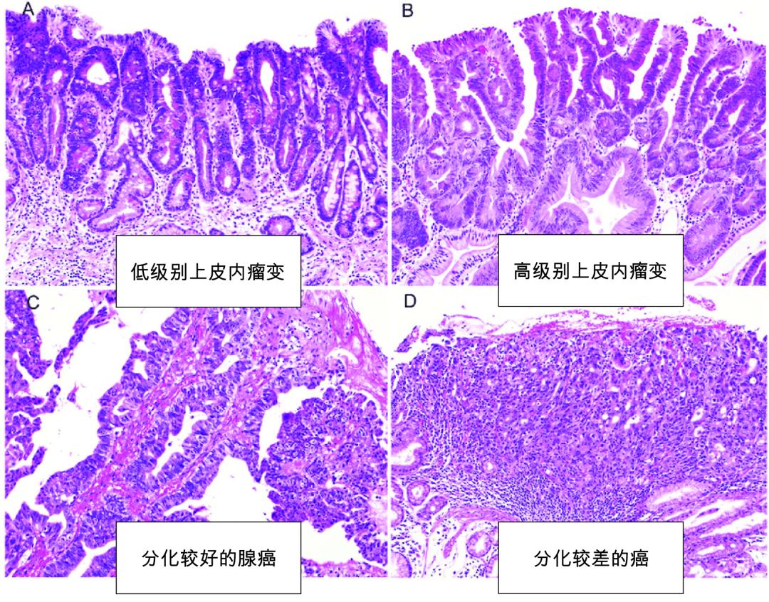 胃镜轻度肠化生到胃癌几年,胃炎肠化是怎么回事